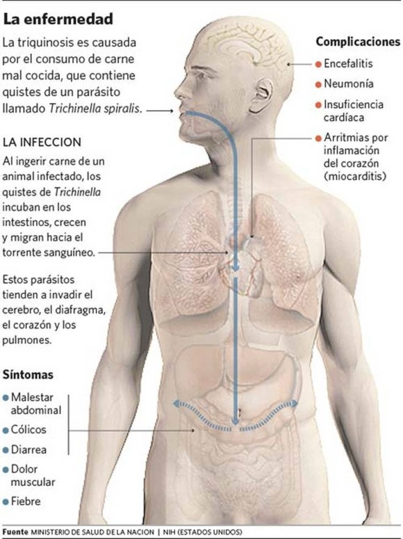 http://www.diariosurdigital.com.ar/guatrache/wp-content/uploads/2010/11/Infografia-Triquinosis.jpg
